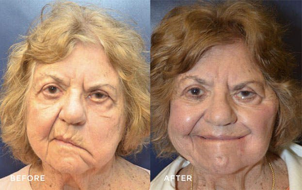 Before and After on real patient